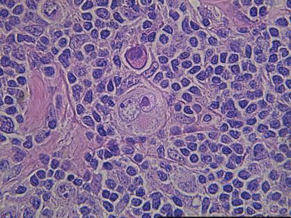 Light Microscope Image of Hodgkin Lymphoma