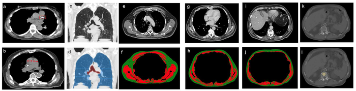 Illustration of Quantitative Analyses of CT Images