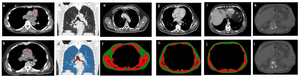 Illustration of Quantitative Analyses of CT Images