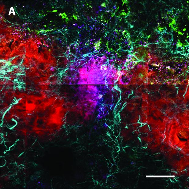 Stiffness Helps Stem Cells Sense and Snuff Metastatic Cancer (2 of 3)