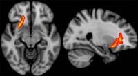 Imaging Predicts Long-Term Effects in Veterans with Brain Injury (2/3)