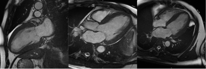 Image: CMR of a patient showing evidence of myocardial hypertrophy (thickening of heart muscles) due to hypertension.