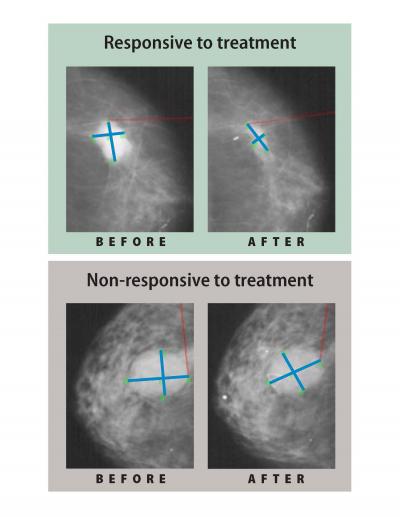 Mammograms of Estrogen-Receptor Positive Breast Tumors
