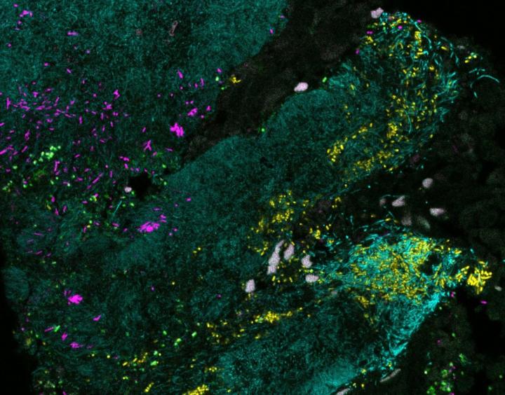 Bacteria Forming a Mixed Biofilm on Colon Cancer Tissue