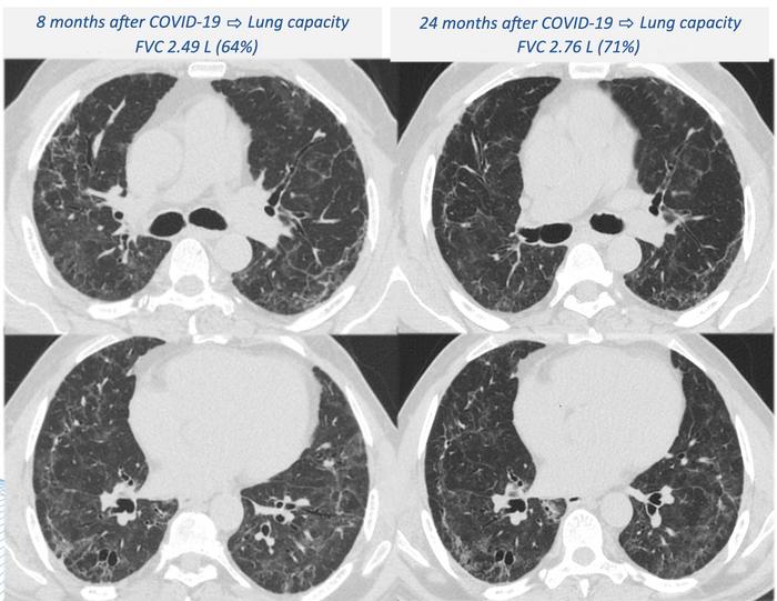 A small number (2%) of participants with fibrotic-like lesions displayed an improvement in their lungs compared with the assessment performed one year after discharge, but many more (25%) had worsened (image: HC-FM-USP)  COVID-19 Lung complications can w