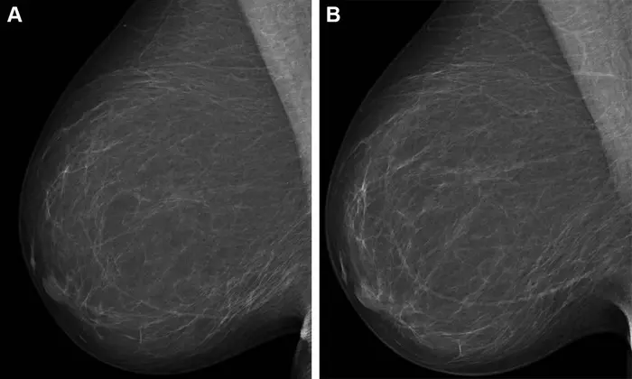 Full-field digital mammograms (right mediolateral oblique view)