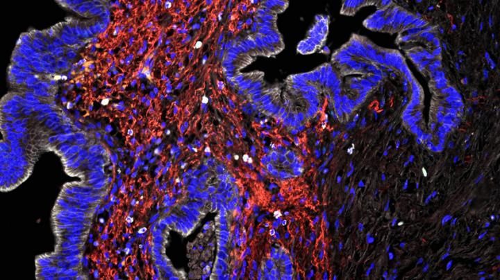 Pancreatic Cancer cells