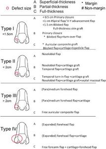 CLASSIFICATION AND TREATMENT ALGORITHM FOR NASAL ALAR DEFECT