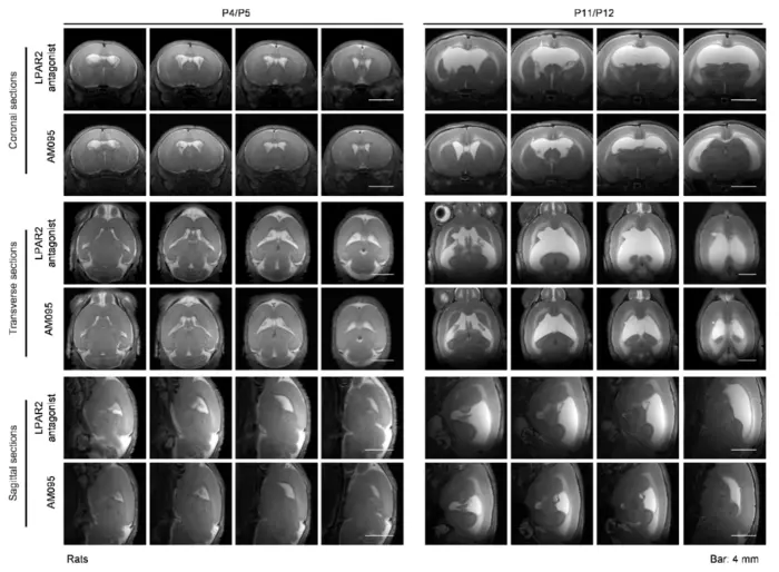 LPAR1 antagonist effectively alleviates Rgs22 deficiency-induced ventricular enlargement.