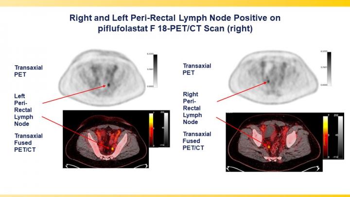 Right and Left Peri-Rectal Lymph Node Positive on piflufolastat F 18-PET/CT Scan (right)