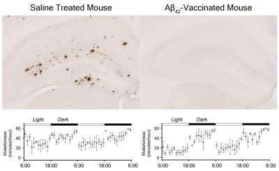 Is Amyloid-Beta Keeping You Up at Night?