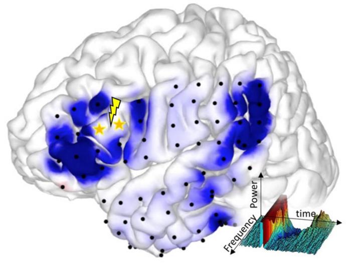 Electric brain stimulation [IMAGE] | EurekAlert! Science News Releases