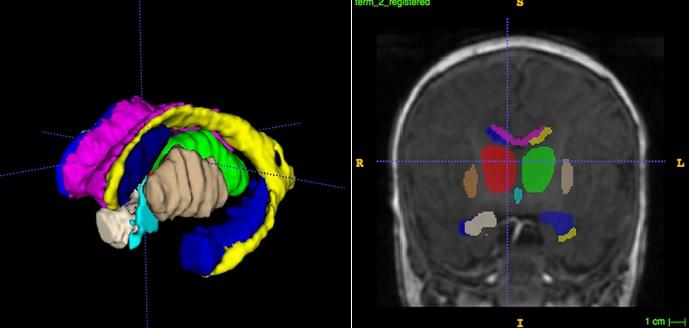 MRI of the Brain of a Full-term Newborn Infant