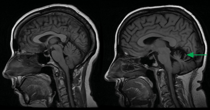 Patient with spinocerebellar ataxia