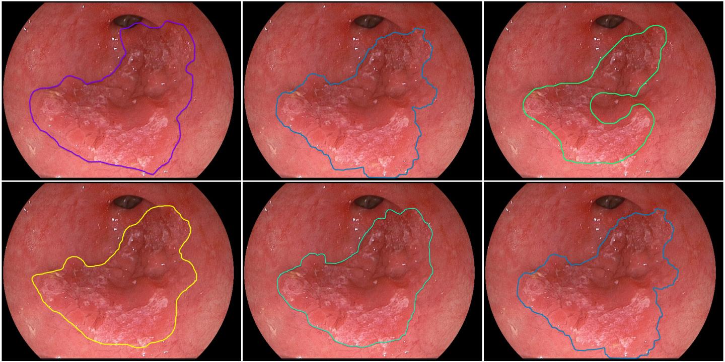 Computer Detection Vs Expert Detection of Early Esophageal Cancer