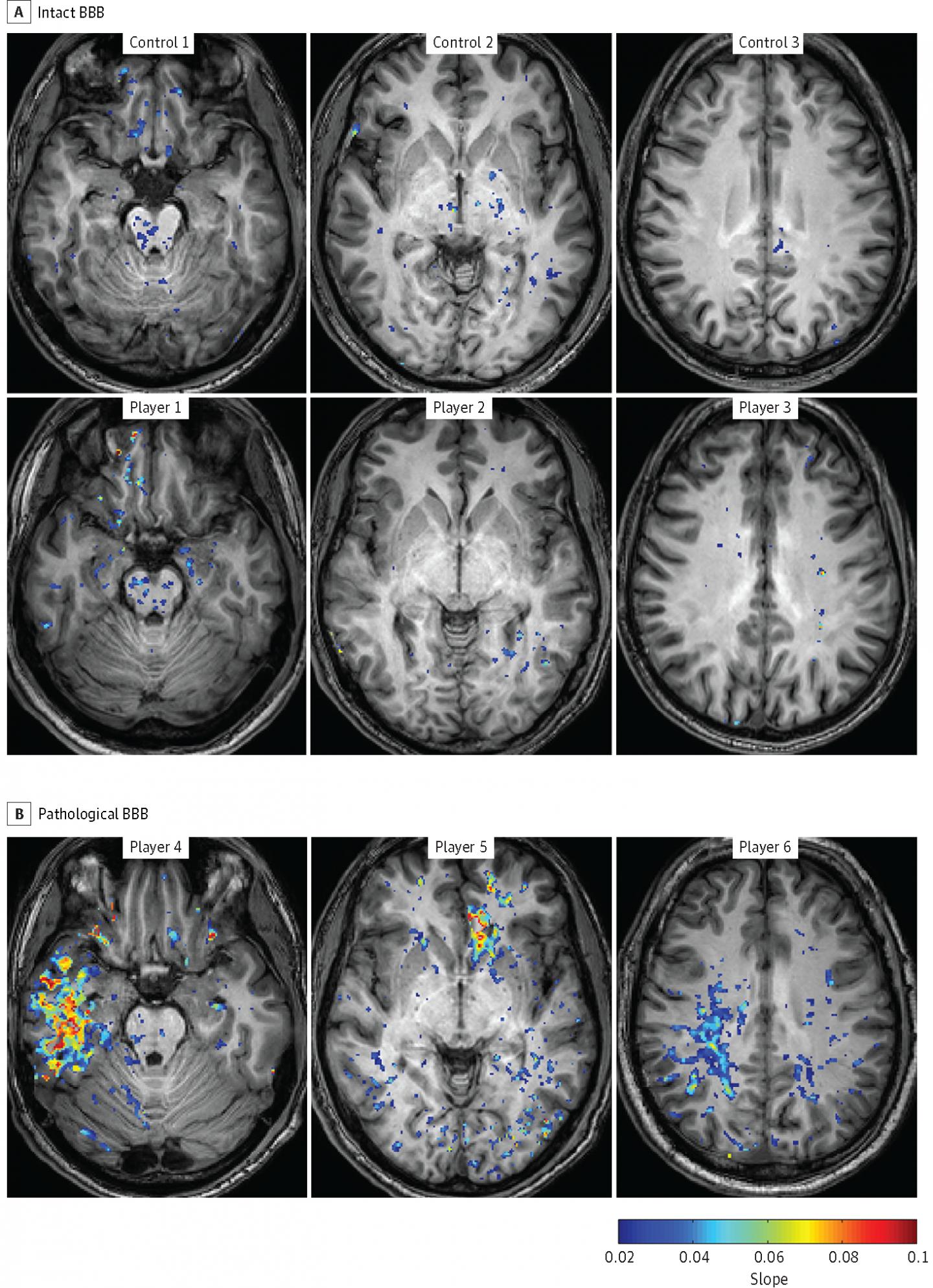 football-players-found-to-have-brain-damage-f-eurekalert