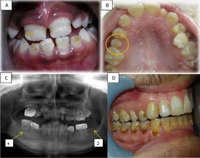 Comparison of dental anomalies between the groups with impacted