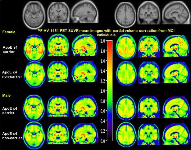 Alzheimer S Disease Sex Affects Tau Accumulation In The Brain Science Codex