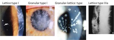 Examples of Corneal Dystrophy
