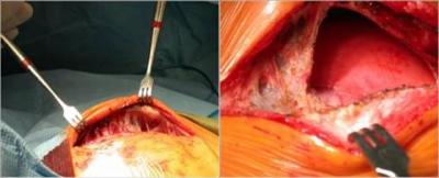 Eliminating Adhesions After Surgery