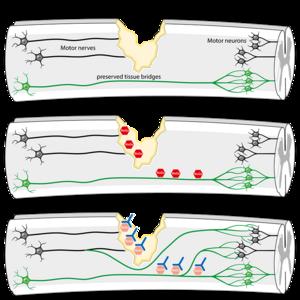 Formation of new nerve connections after acute spinal cord injury