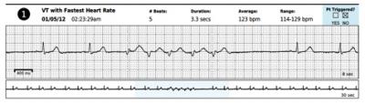 A Record of Ventricular Tachycardia