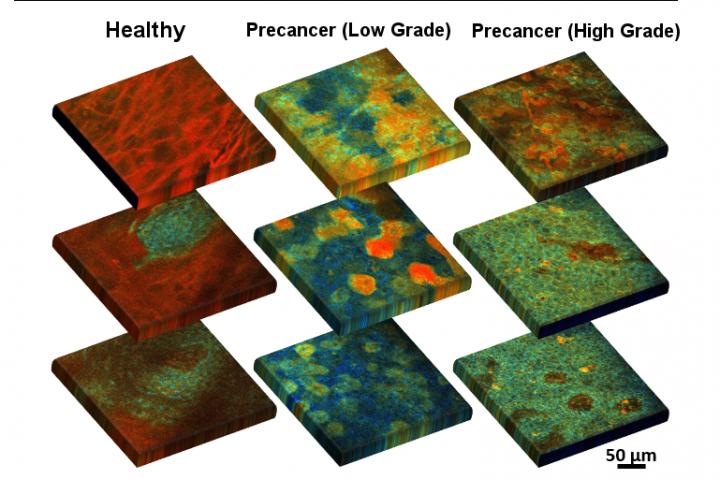 Visualizing Metabolism in Precancerous Tissue