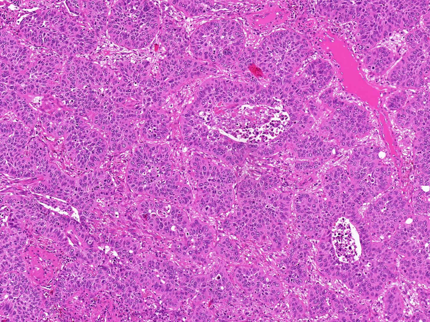 Histology Slide of a Primary Lung Cancer