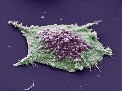 Lung Cancer Cell