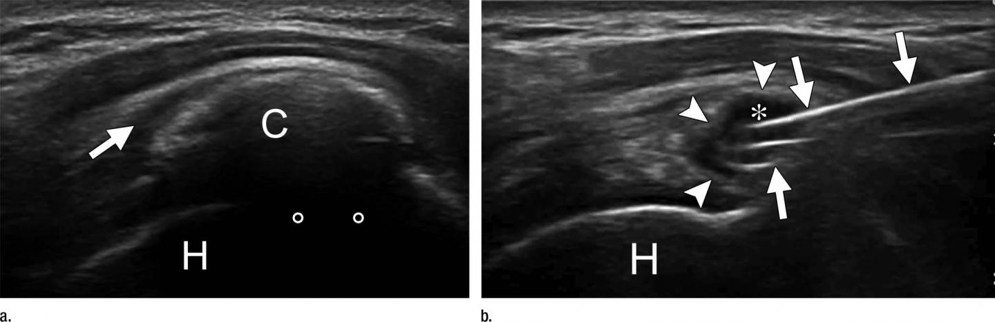 Supraspinatus Calcification