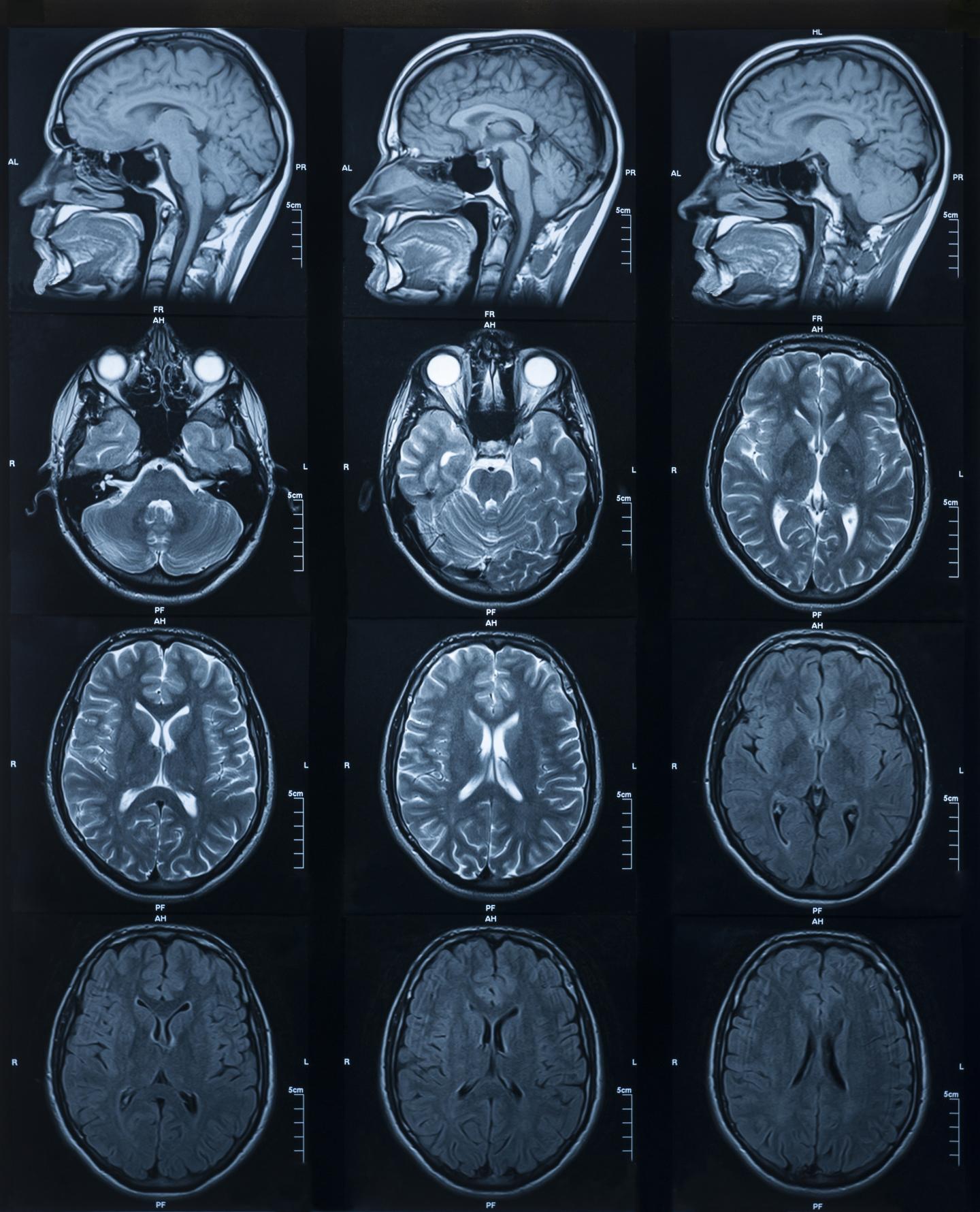 mri scan brain normal