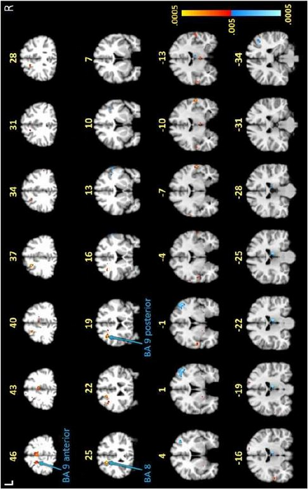 Post-Lyme disease brain activation