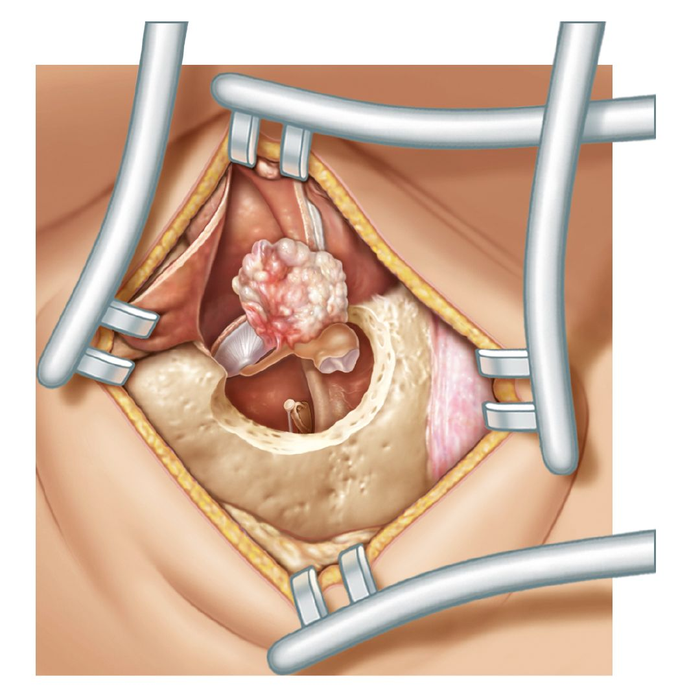 Illustration of the surgical exposure of a cholesteatoma