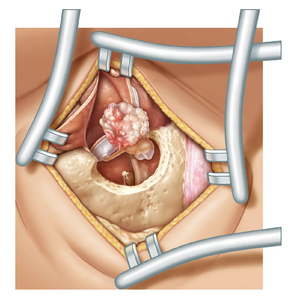 Illustration of the surgical exposure of a cholesteatoma