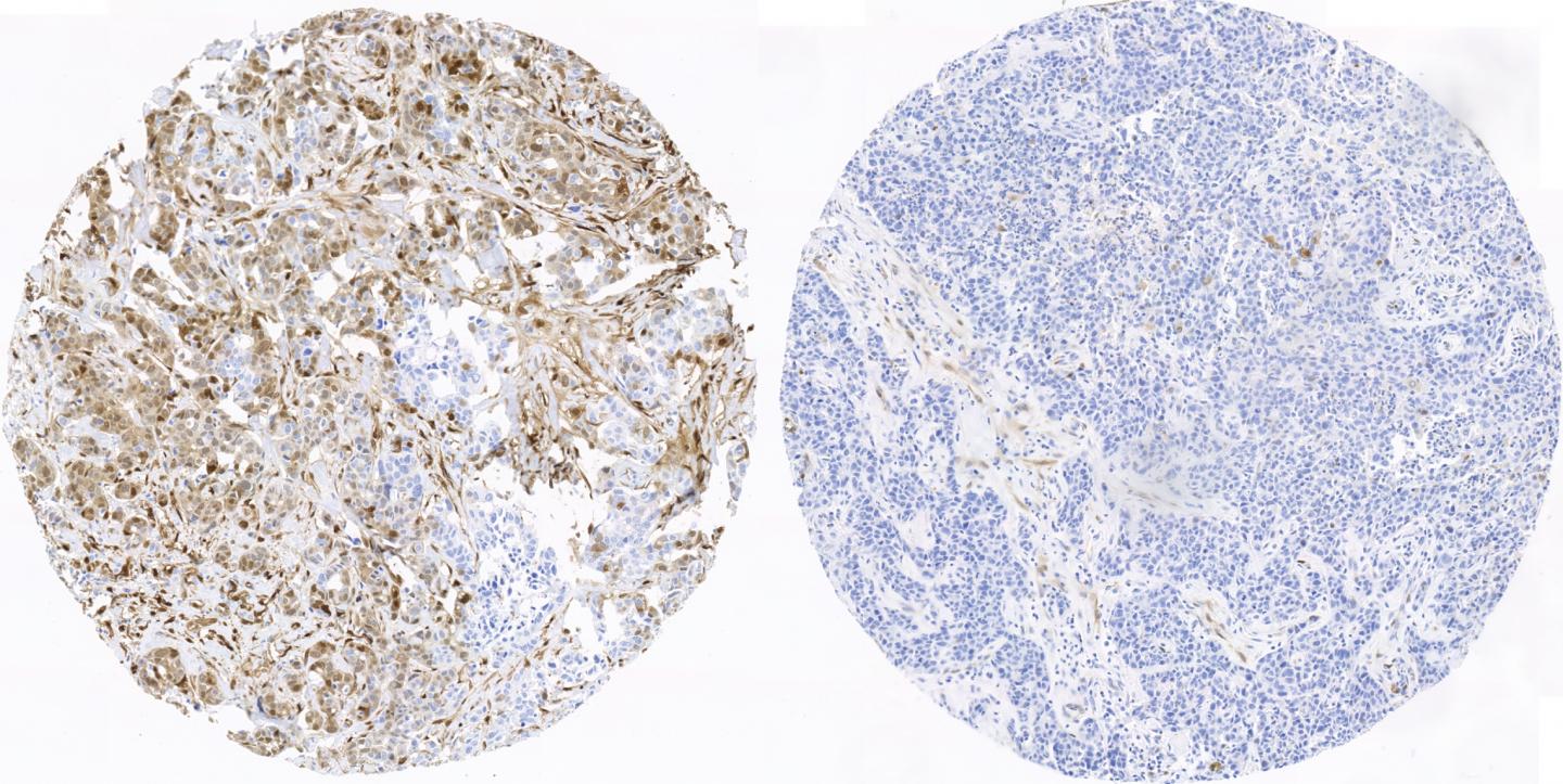 Breast Tissue from a Relapsed Patient Compared to Breast Tissue from a Patient without Relapse