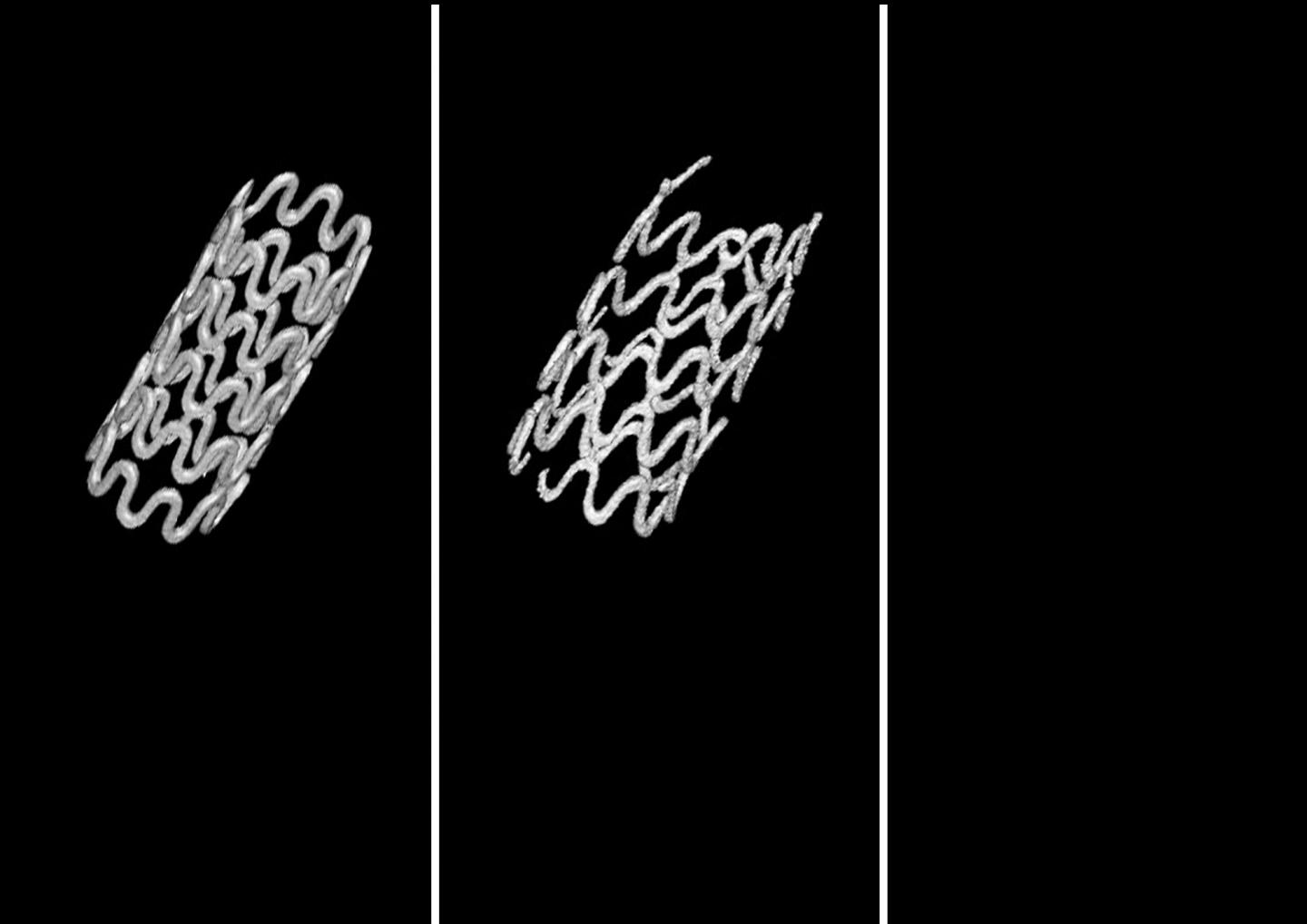 Biodegradable Magnesium-alloy Tracheal Stent