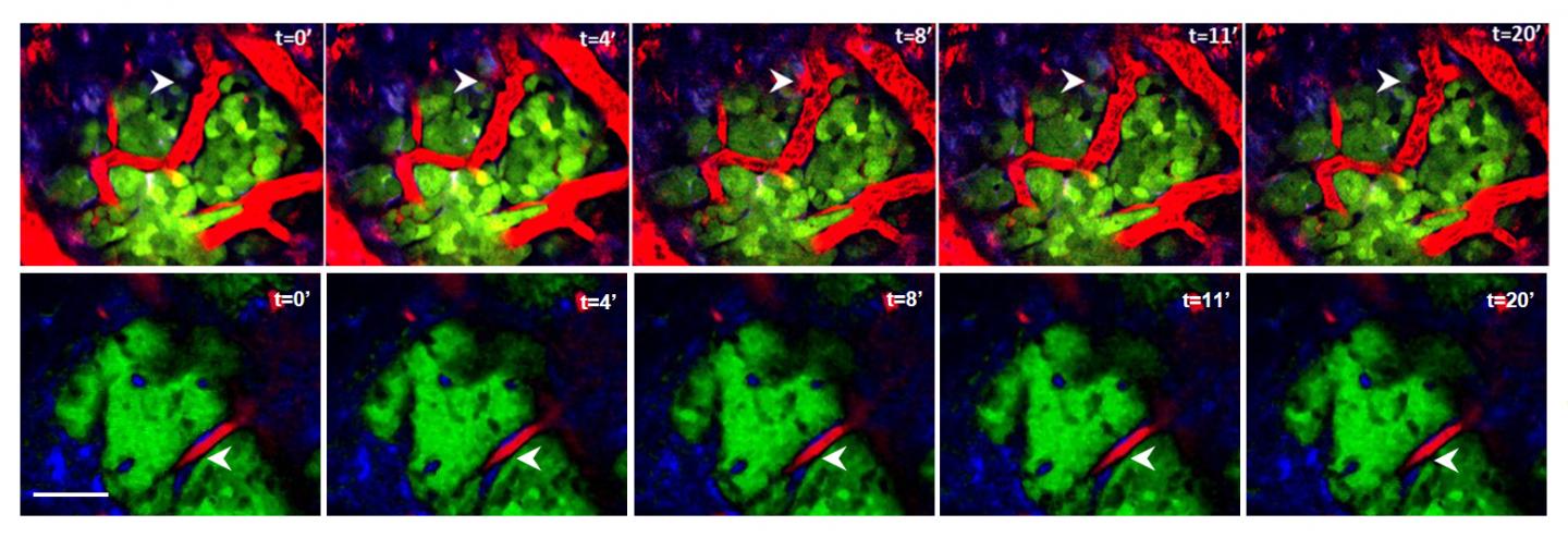 Chemotherapy Shrinks Tumors, But May Help Cancer Spread (1 of 3)