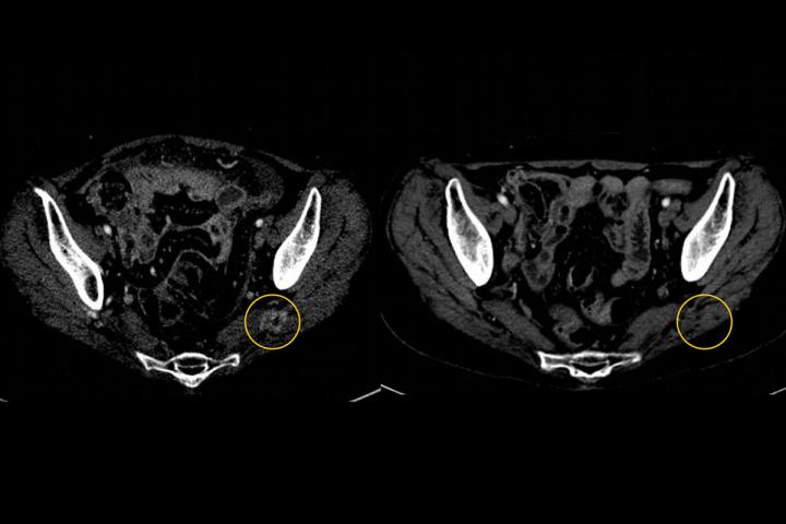 Newly approved drug effective against lung cancer caused by genetic mutation