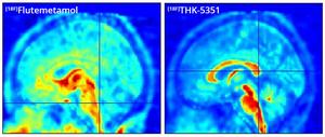 Deposition of amyloid and tau in ederly patient