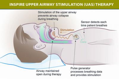 Electronic Stimulation of Upper Airway for Obstructive Sleep Apnea
