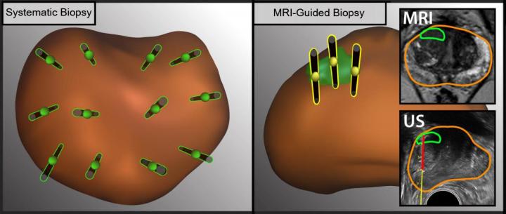 Biopsy on prostate