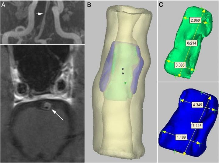 Phantom of a Stenotic Intracranial Artery for MRI standardization