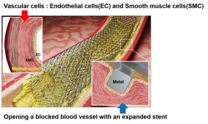 Schematic representation of a metal stent in an opened artery