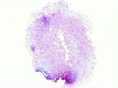 Osteoarthritis Stemcell