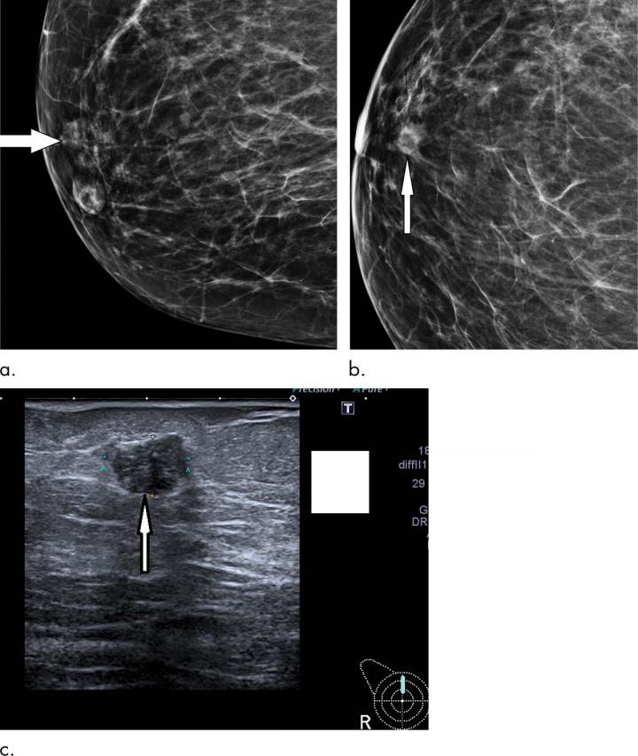 Stage 1 breast cancer