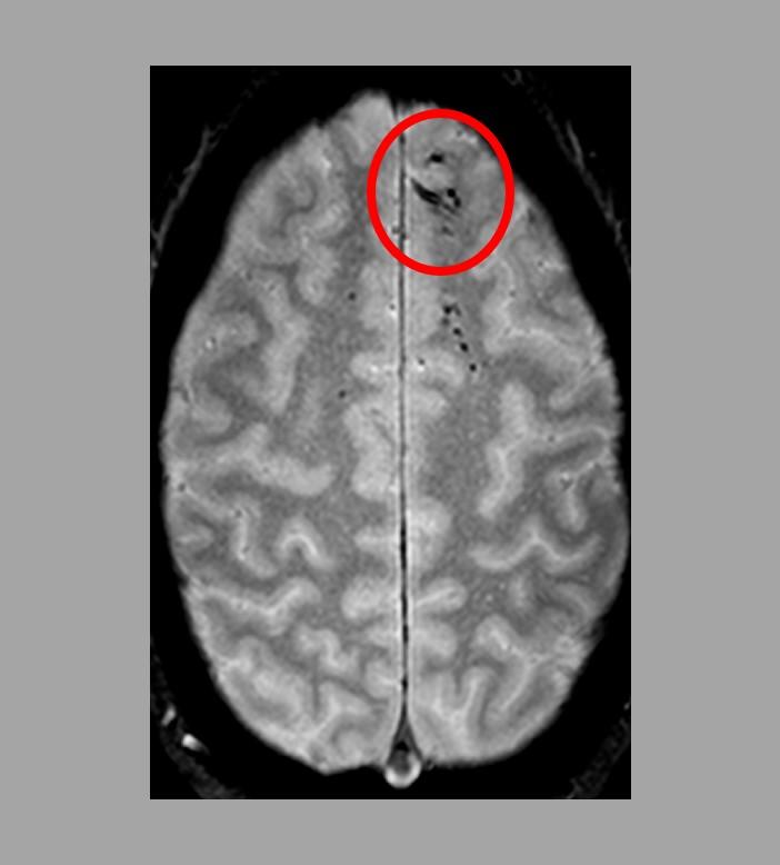 Traumatic Microbleeds in the Brain
