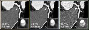 Coronary CT Angiography