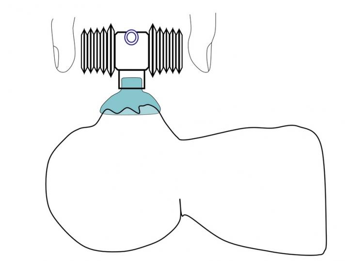 Portable Device Helps Breathing during First Seconds of Life