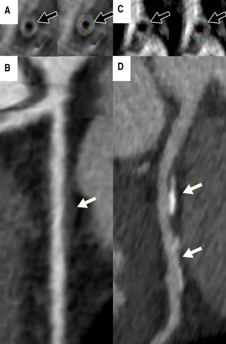 Women with Coronary Artery Wall Thickness at Risk for Heart Disease