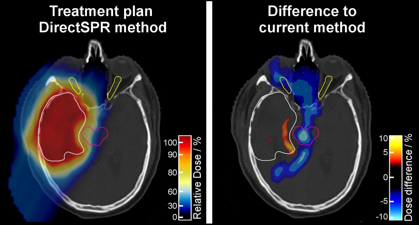 Treatment Plan Based on the DirectSPR Method